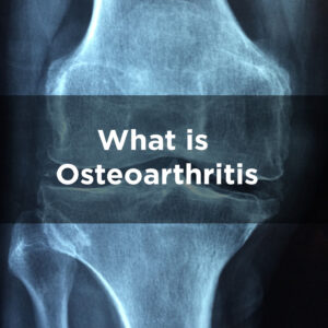 What is Osteoarthritis? – Kneele